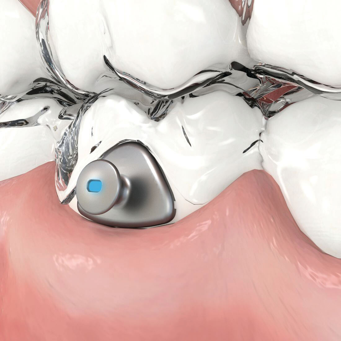 Aligner Buttons, Metall