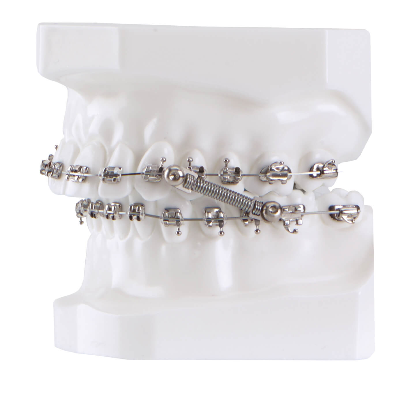 CS5 Twist Lock, 5-Patienten Kit (10 mm)