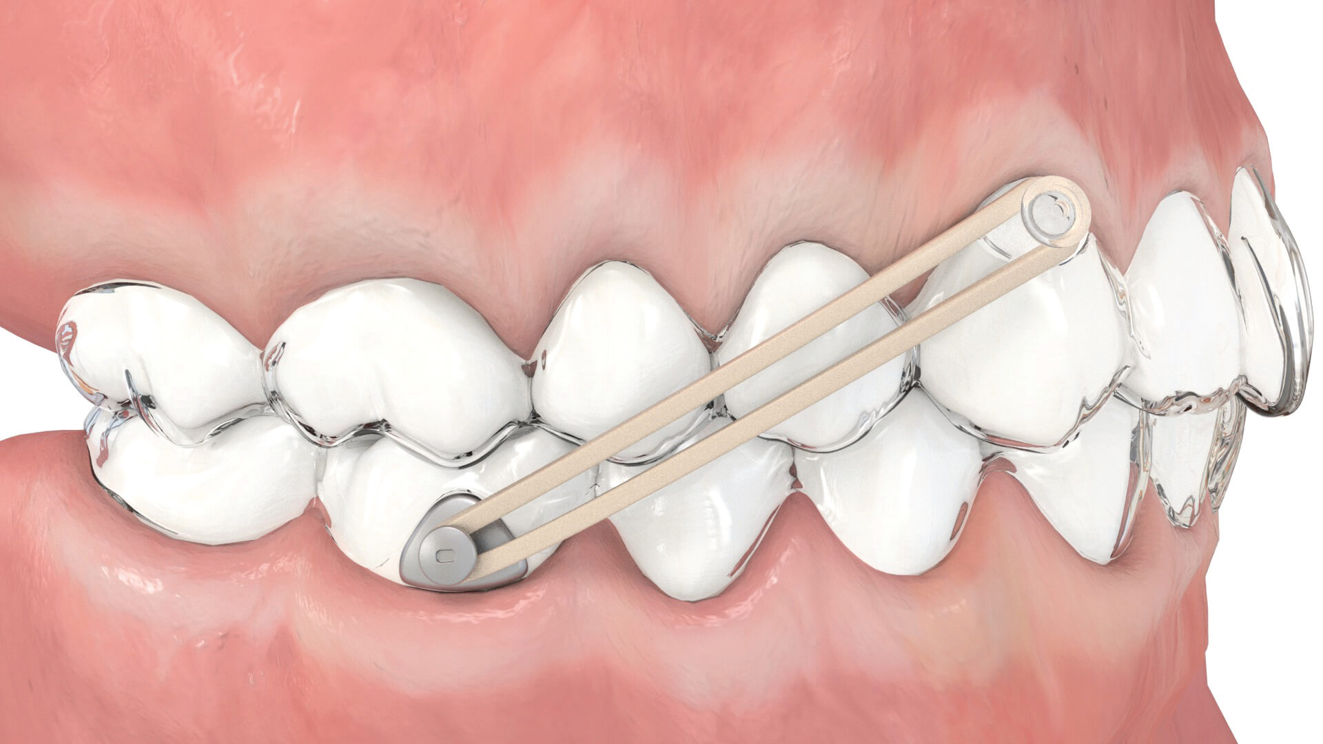 Aligner Buttons, Metall