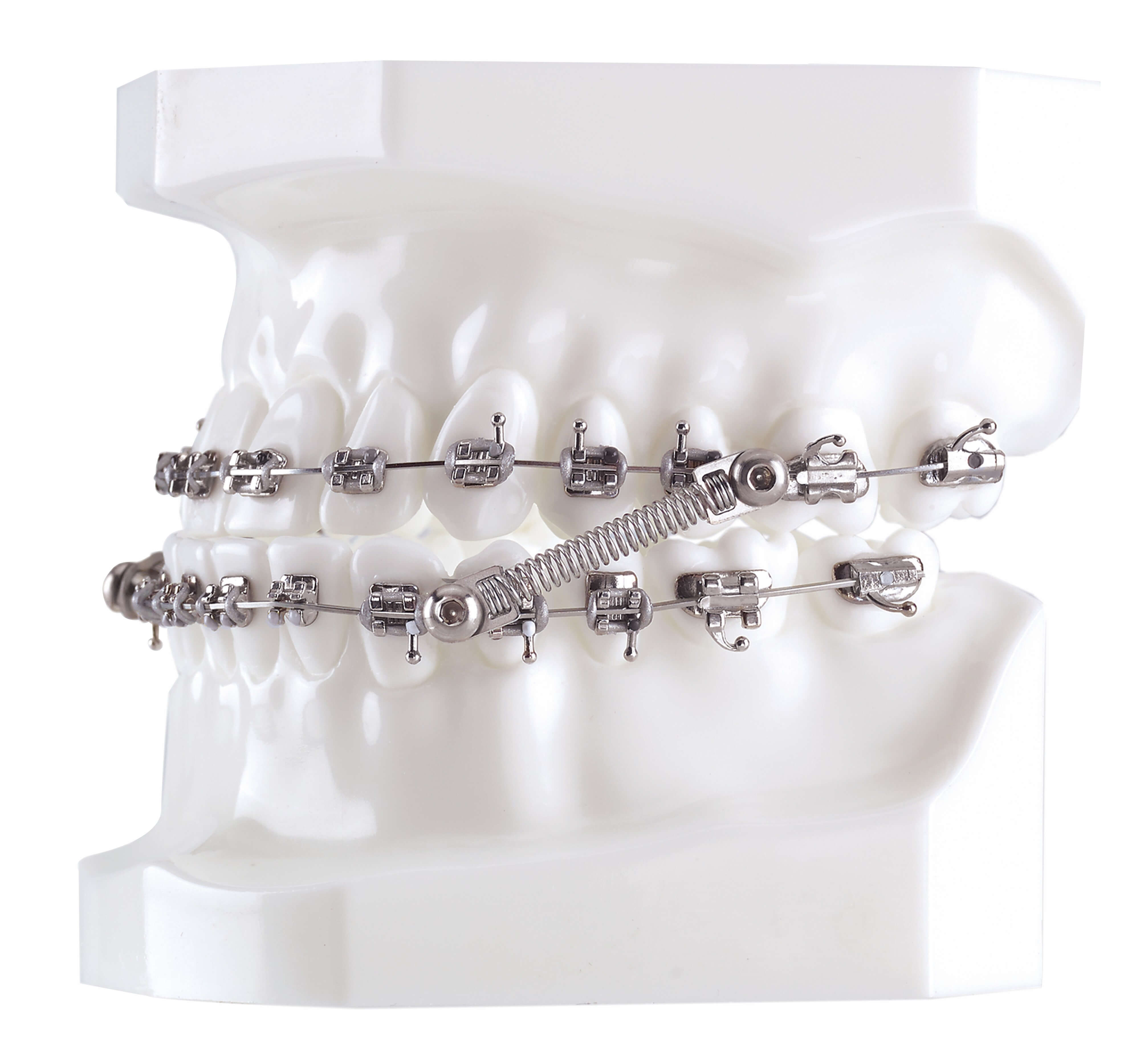 CS5 Twist Lock, 5-Patienten Kit (10 mm)