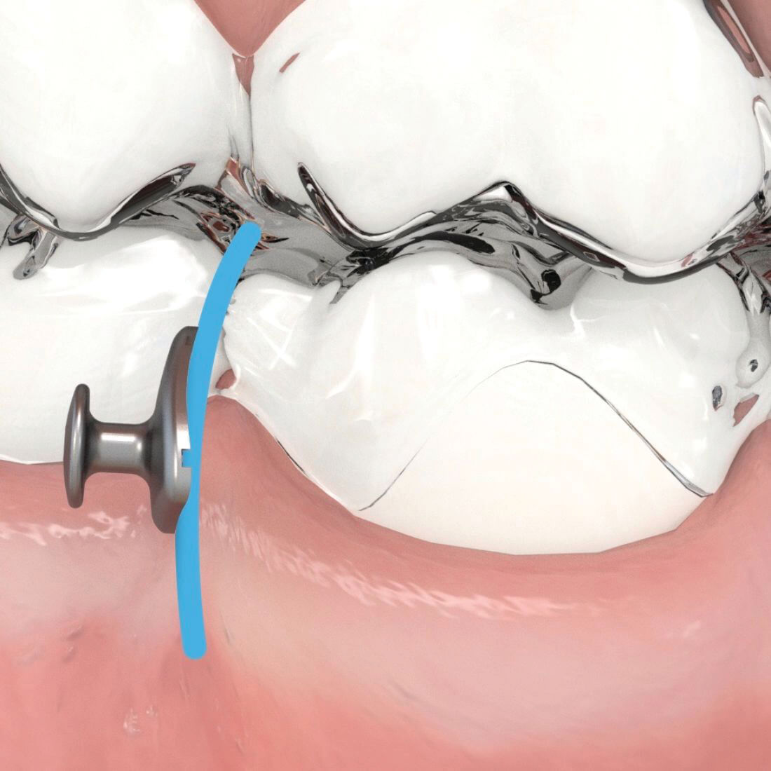 Aligner Buttons, Metall