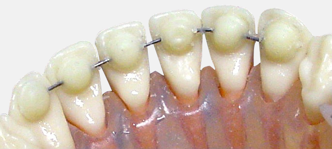 Mini Mold® Retainer, groß