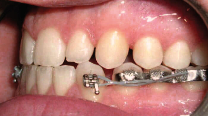 Netzbasis-Retainer