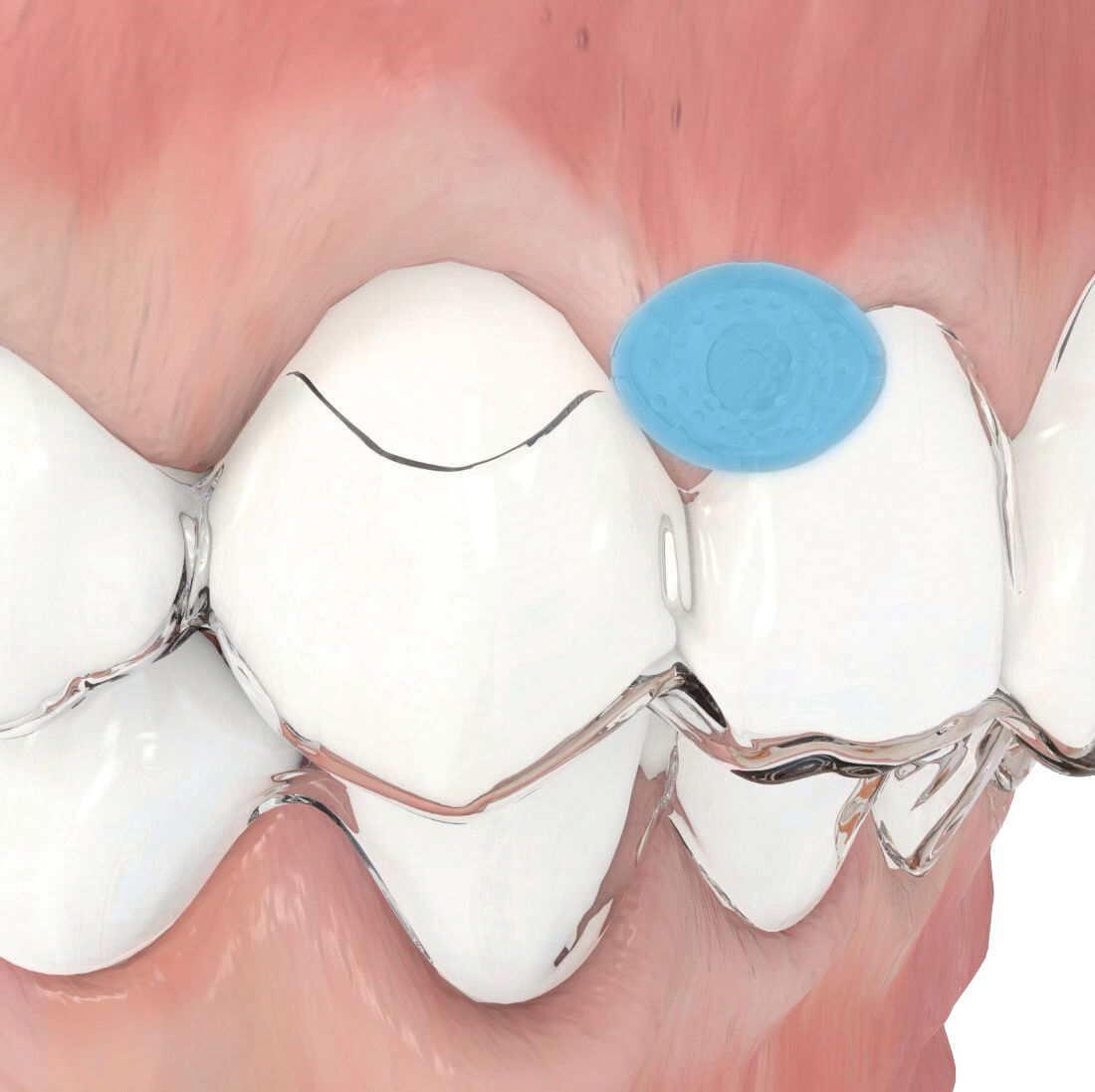 Aligner Buttons, Metall