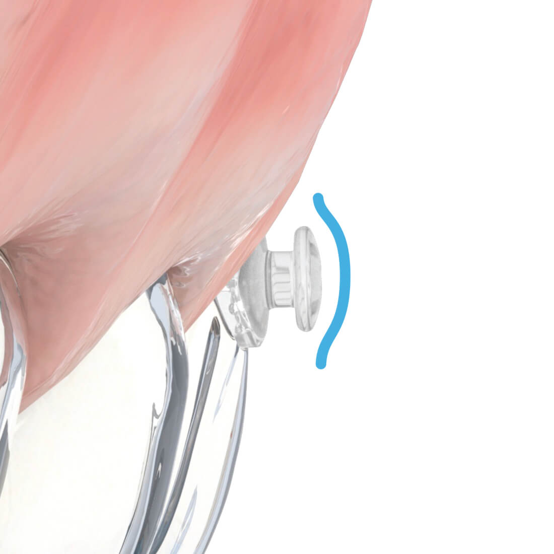 Aligner Buttons, Metall